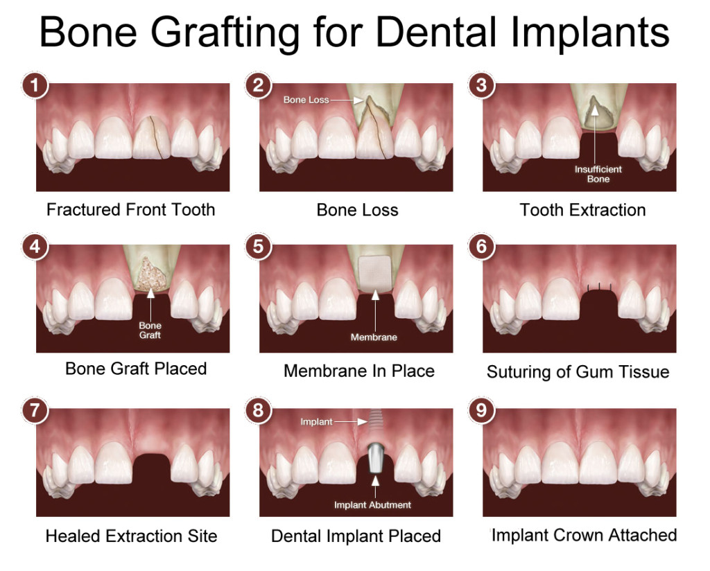 Understand Dental Bone Grafting From Springvale Dentist understand-dental-bone-grafting-from-springvale-dentist