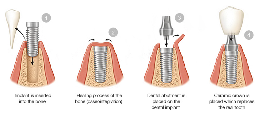 A complete step by step guide to Dental Implant