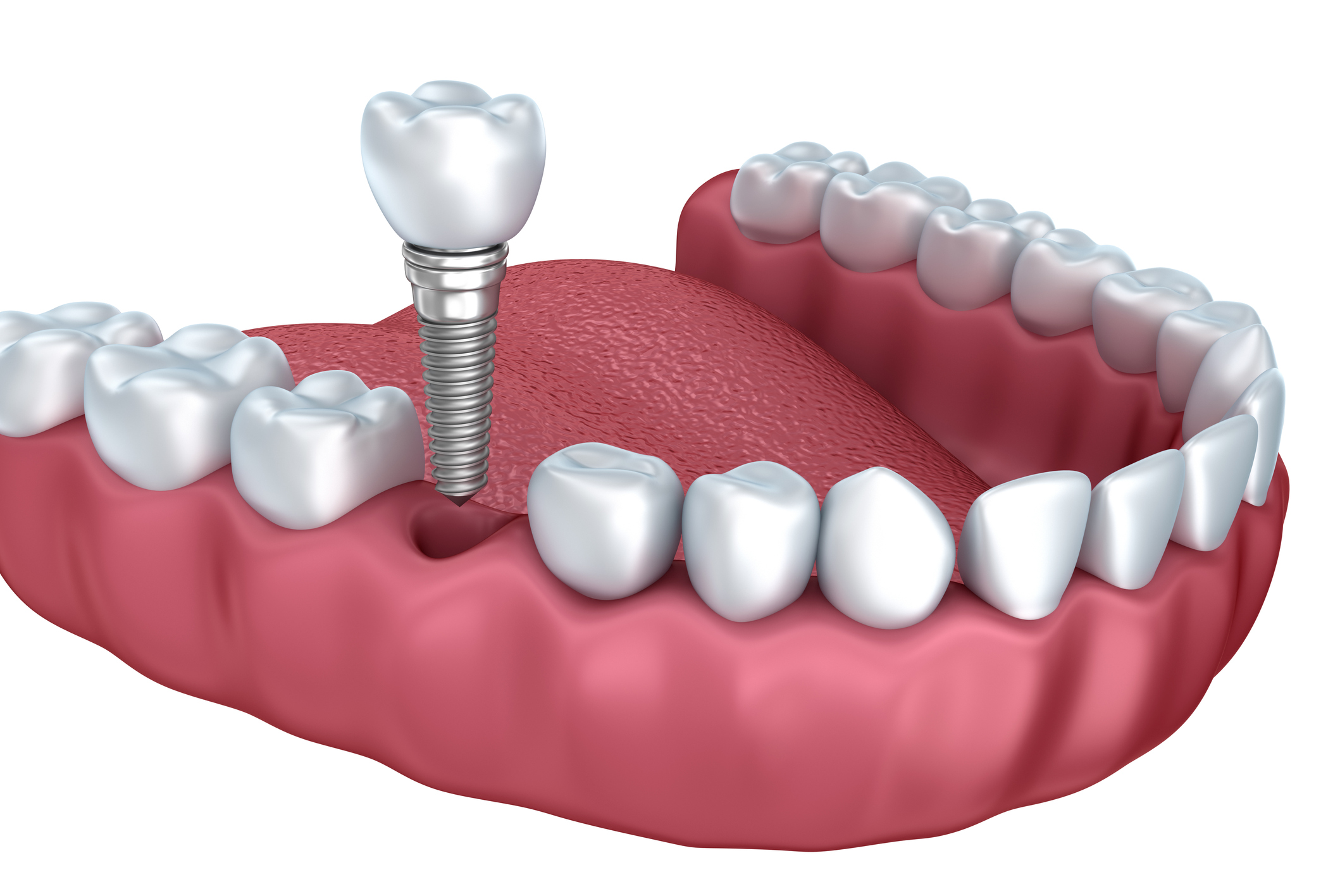 Dental_Implant-2