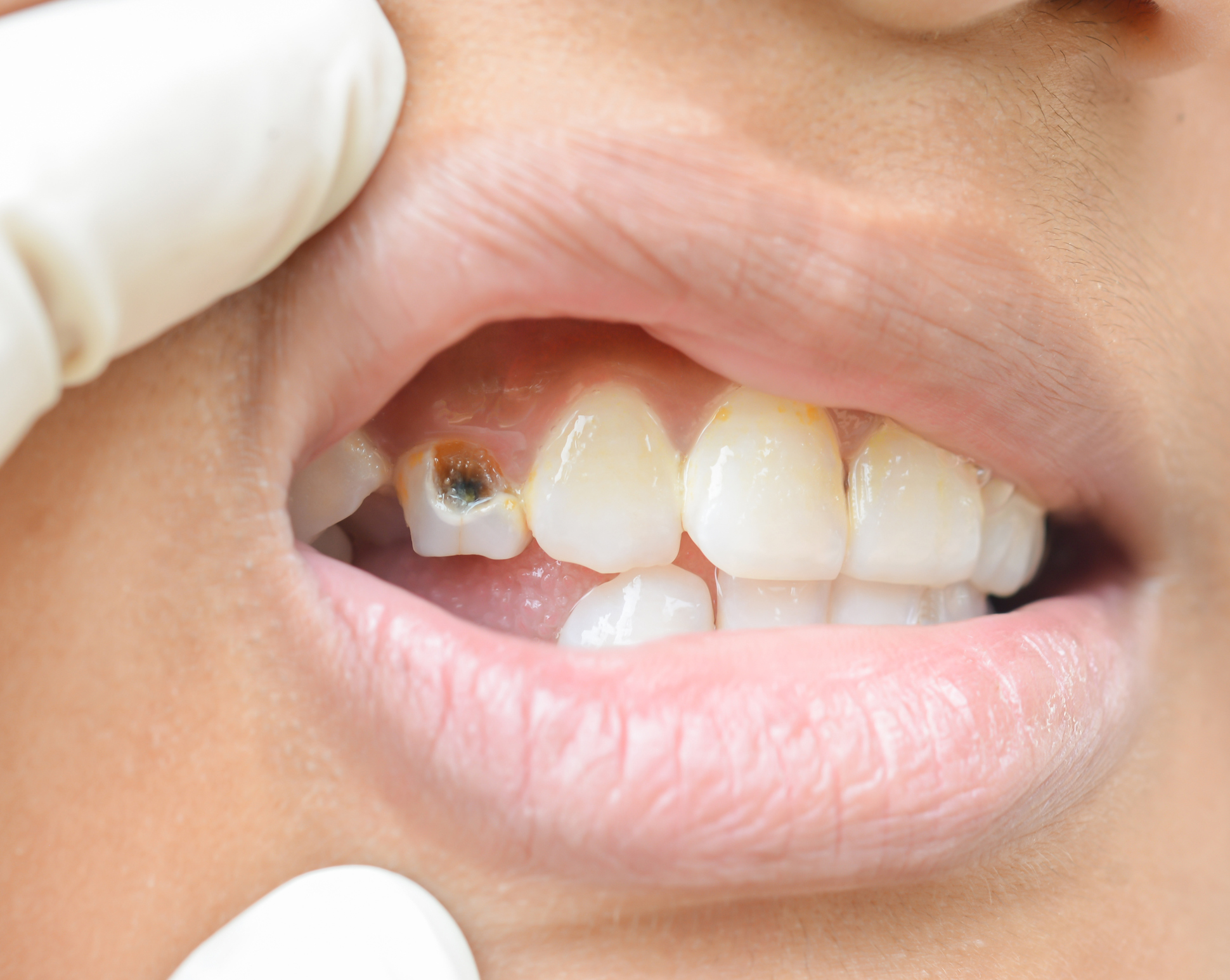 What Causes Craze Lines on Front Teeth?