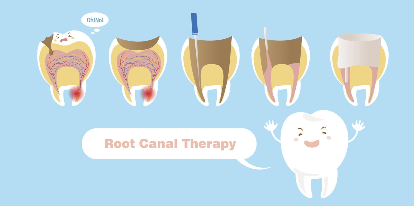 Root canal therapy