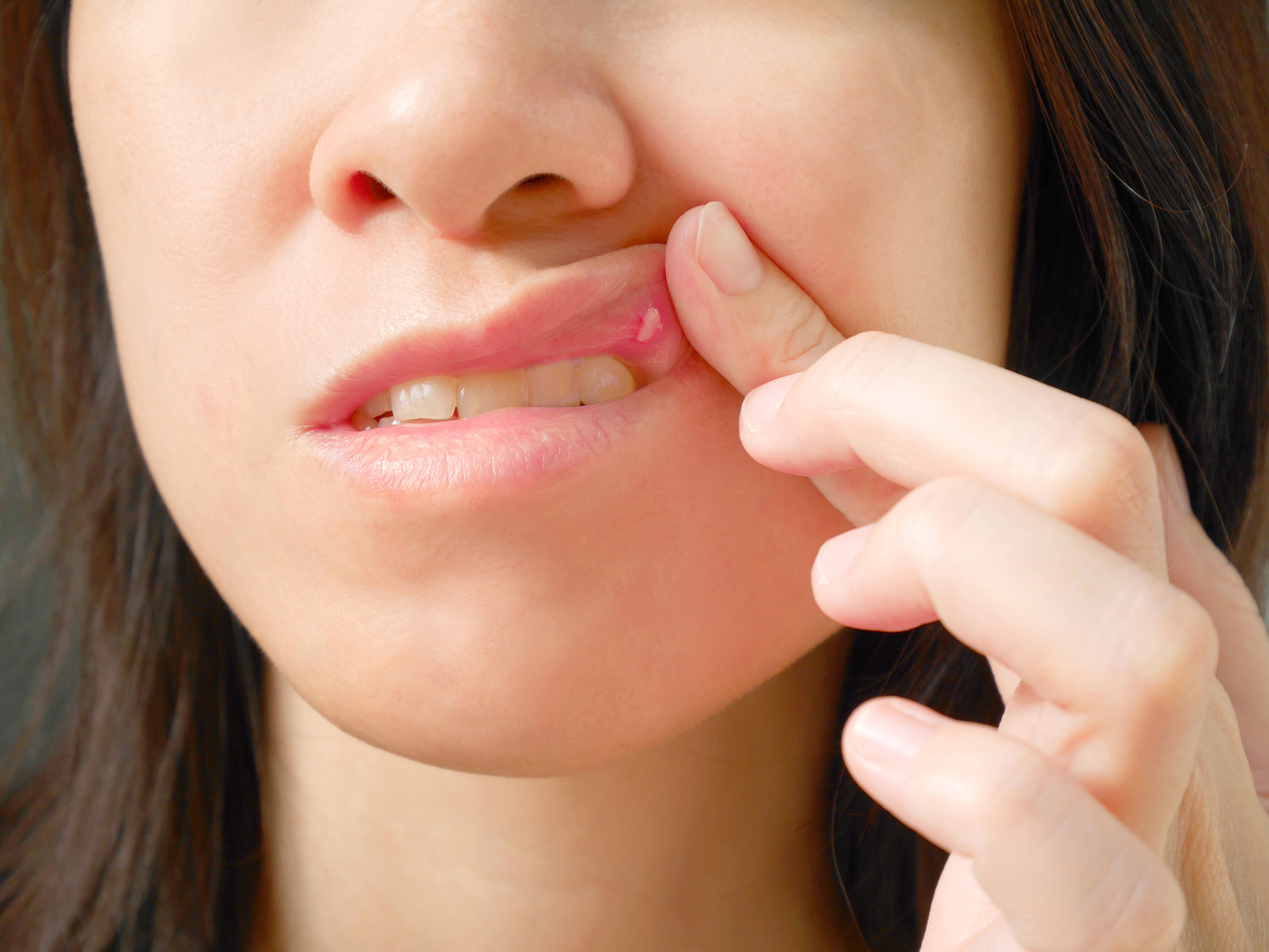 canker sore on cheek near wisdom tooth