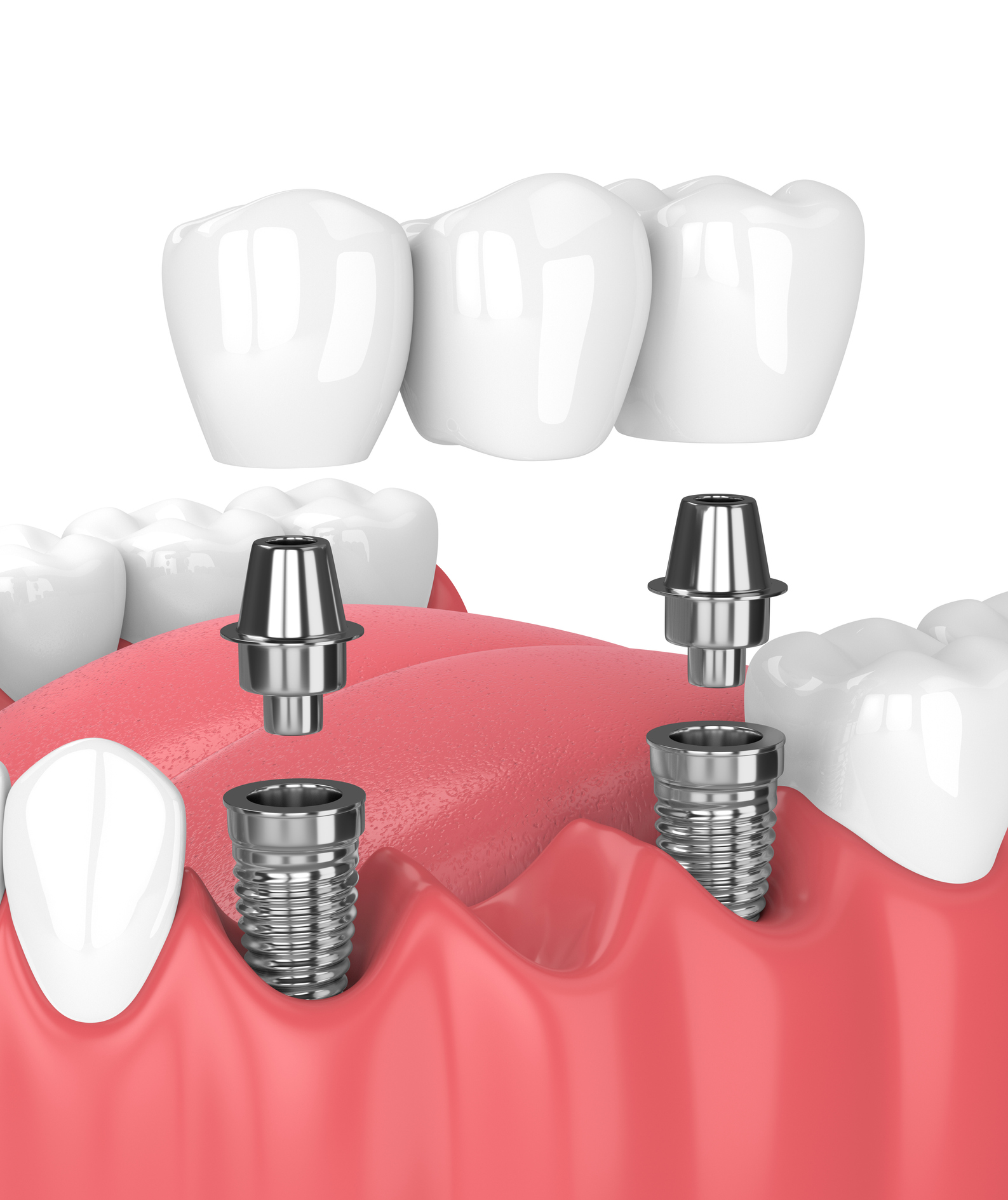 teeth_implant