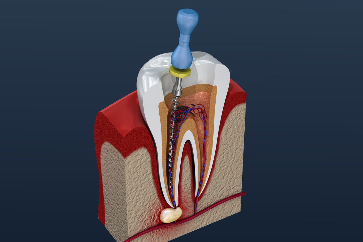 dental abscess treatment