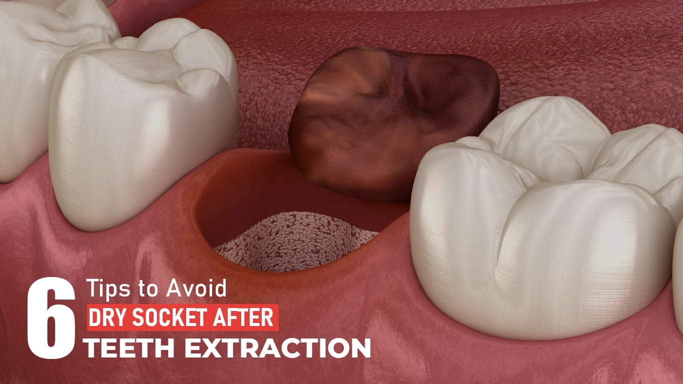 6 Tips to Avoid Dry Socket After Teeth Extraction