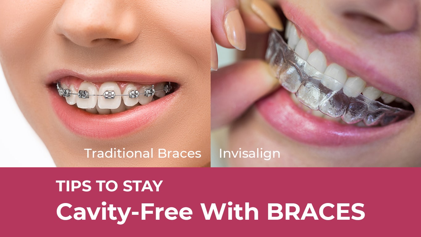 Traditional and invisible braces