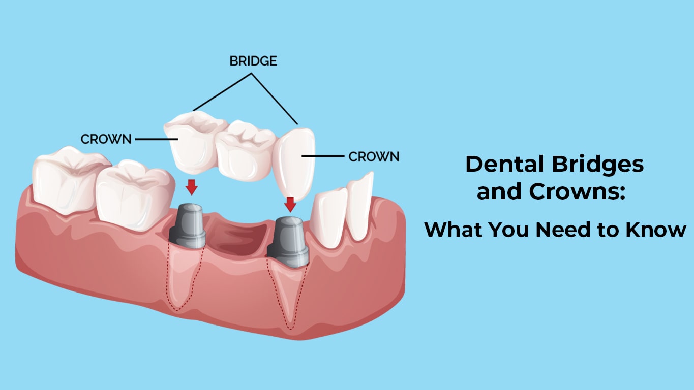 Dental Crowns and Bridges