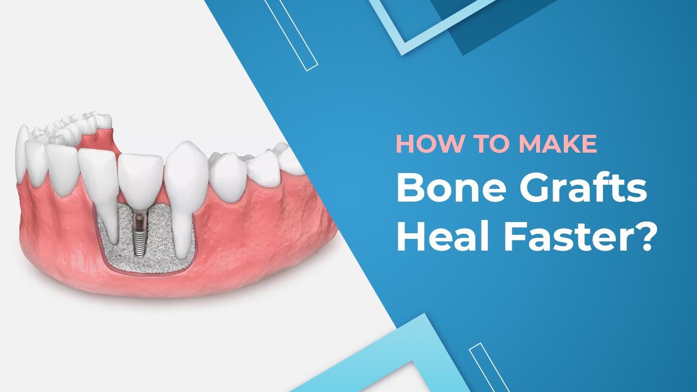 How to Make Bone Grafts Heal Faster