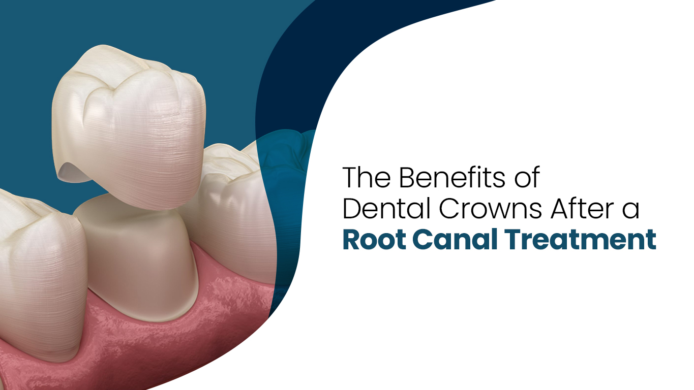 dental crown after root canal treatment