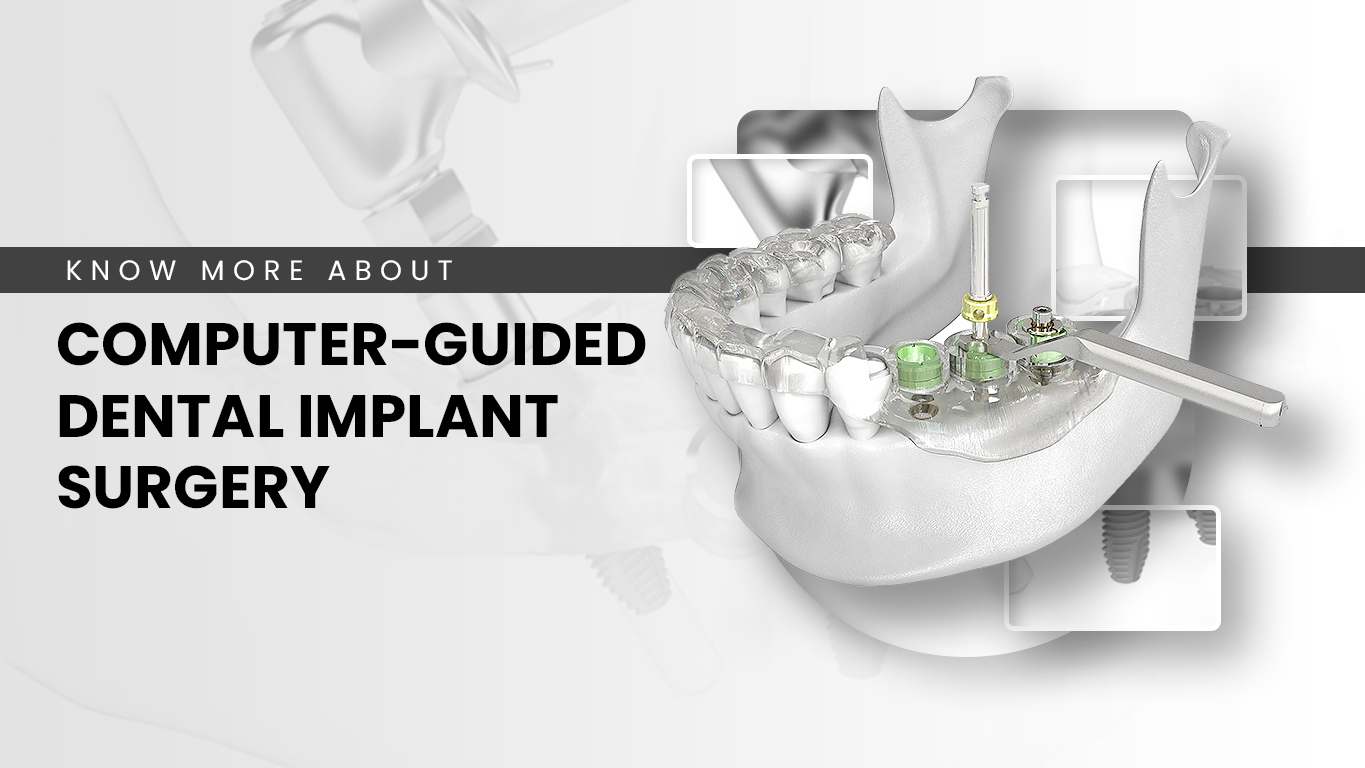 Dental Implants