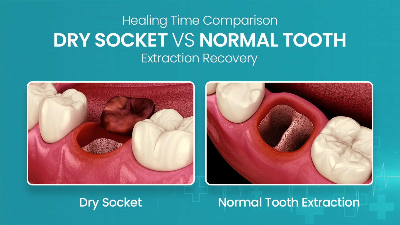 Dry Socket vs Normal Socket tooth extraction