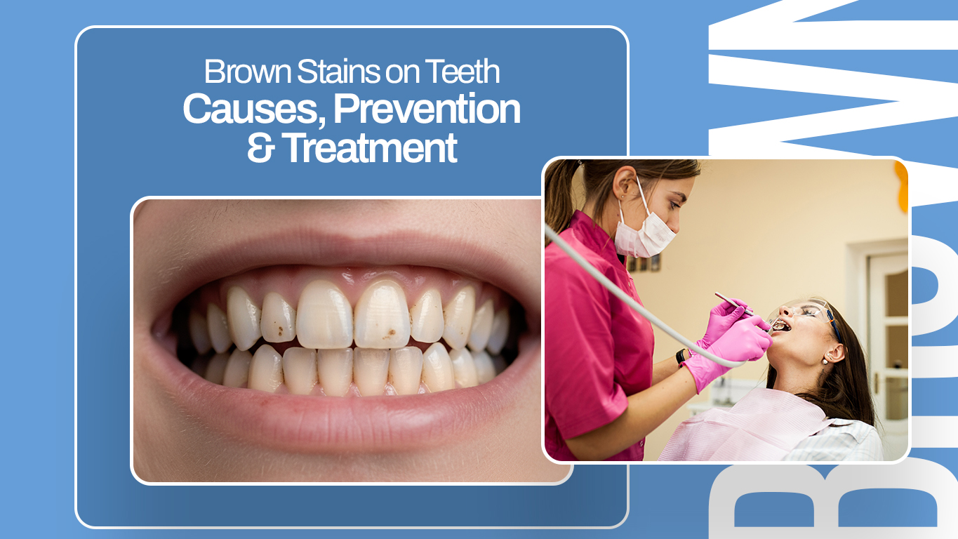 Brown Stains on Teeth