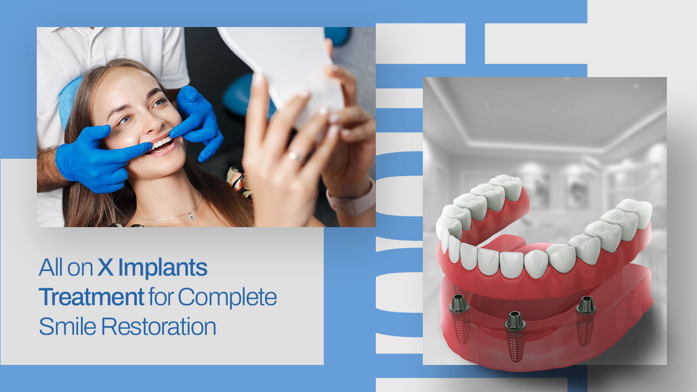All on X Implants Treatment for Complete Smile Restoration