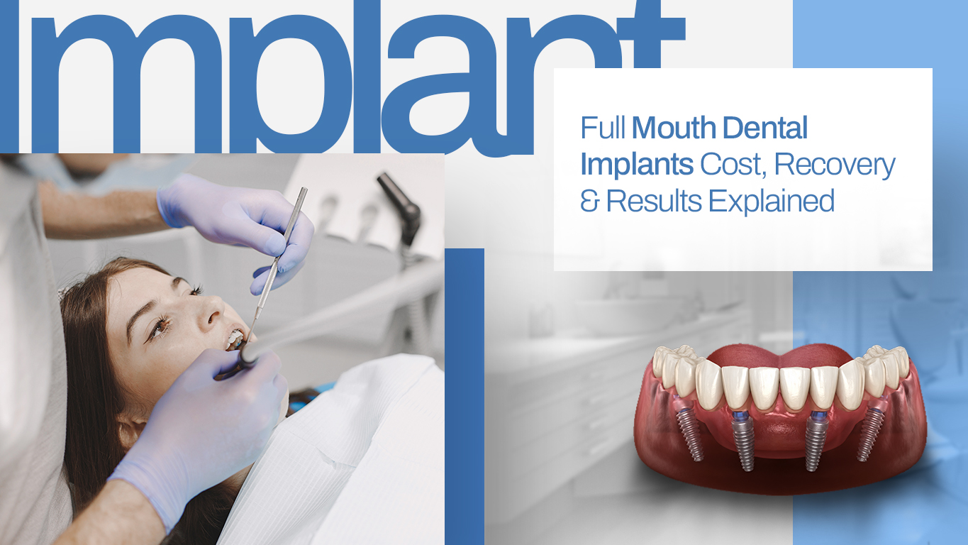Full Mouth Dental Implants Cost, Recovery & Results Explained