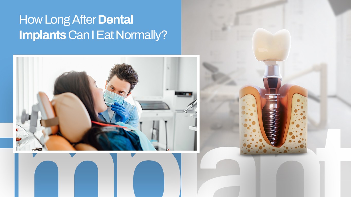 How Long After Dental Implants Can I Eat Normally