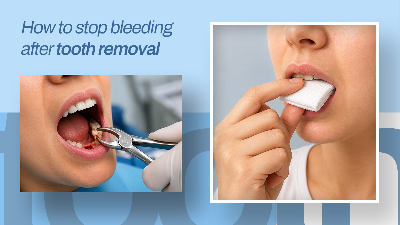 How to Stop Bleeding After Tooth Removal