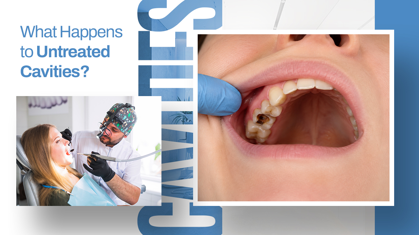 What Happens to Untreated Cavities