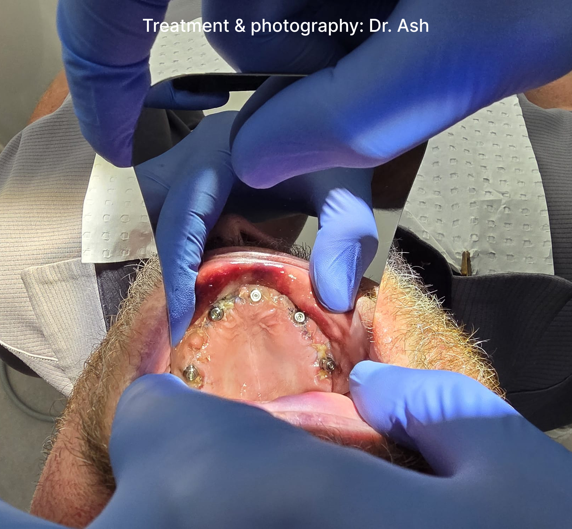 Dental Implant Step2