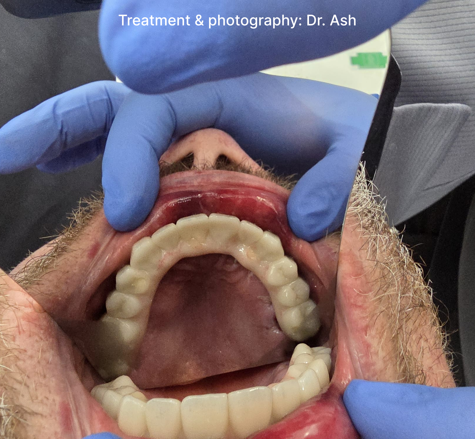 Dental Implant Step3