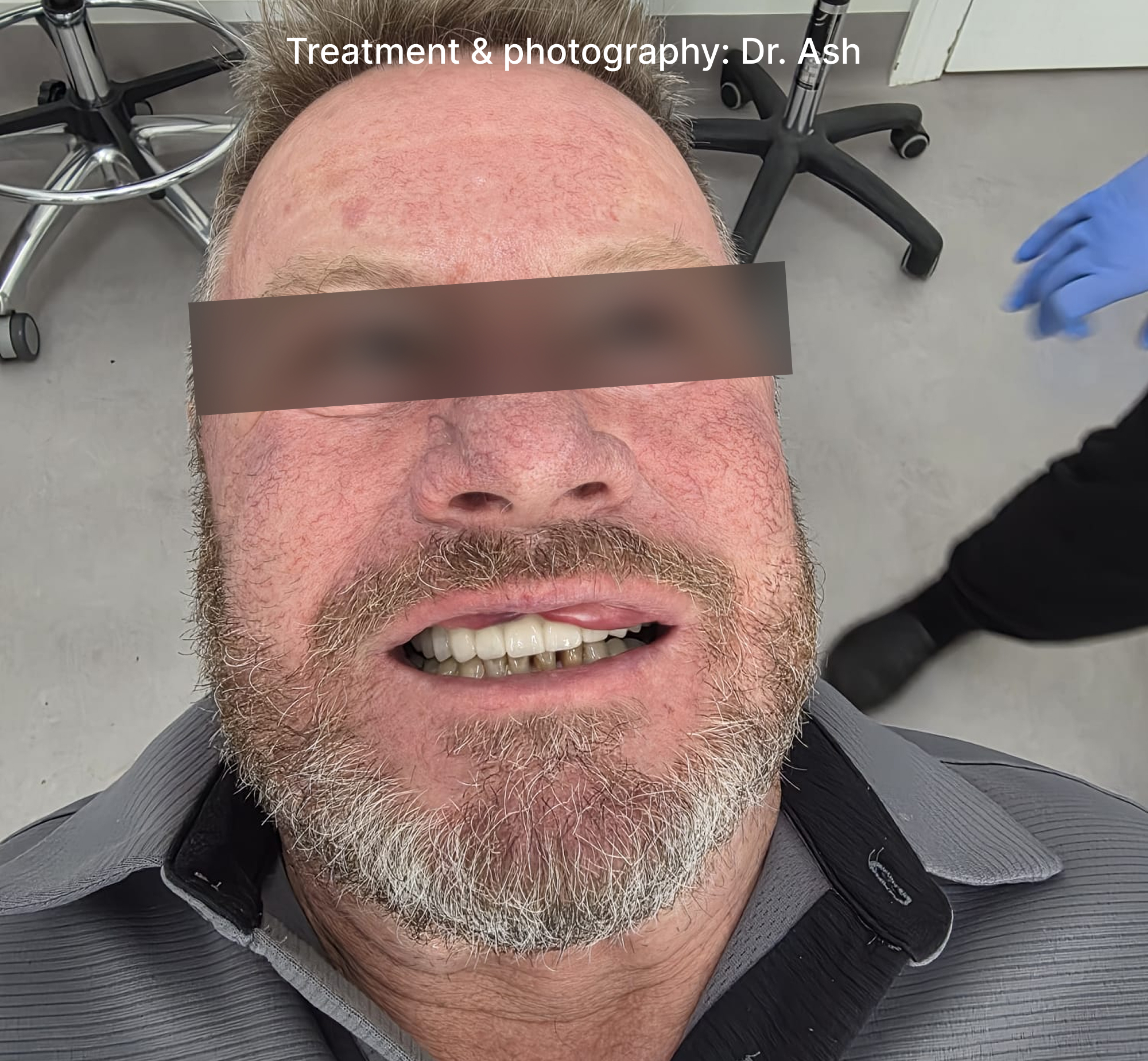 Dental Implant Step4