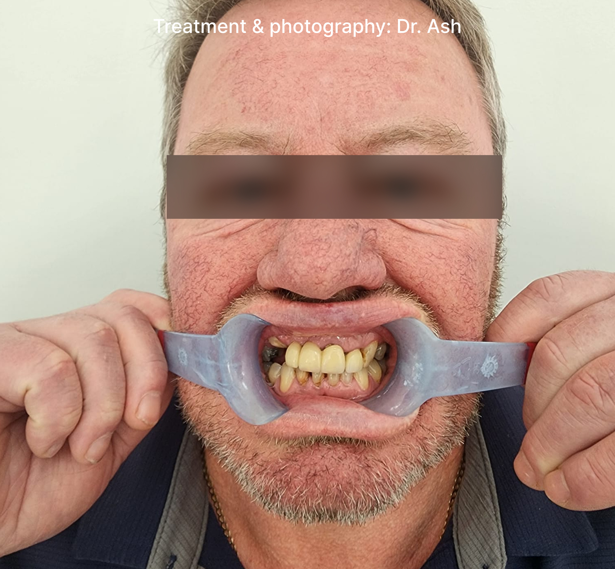 Dental Implant Step1